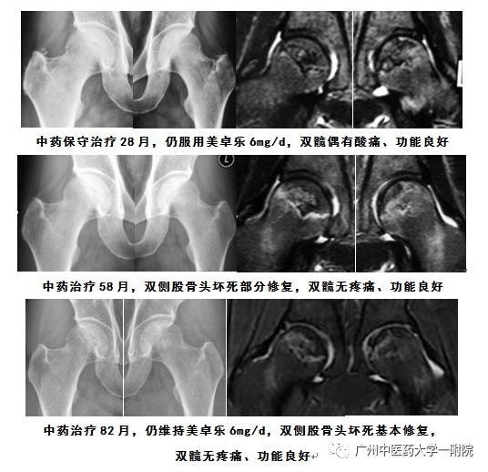 最新股骨頭壞死療法，為患者帶來希望之光的新征程